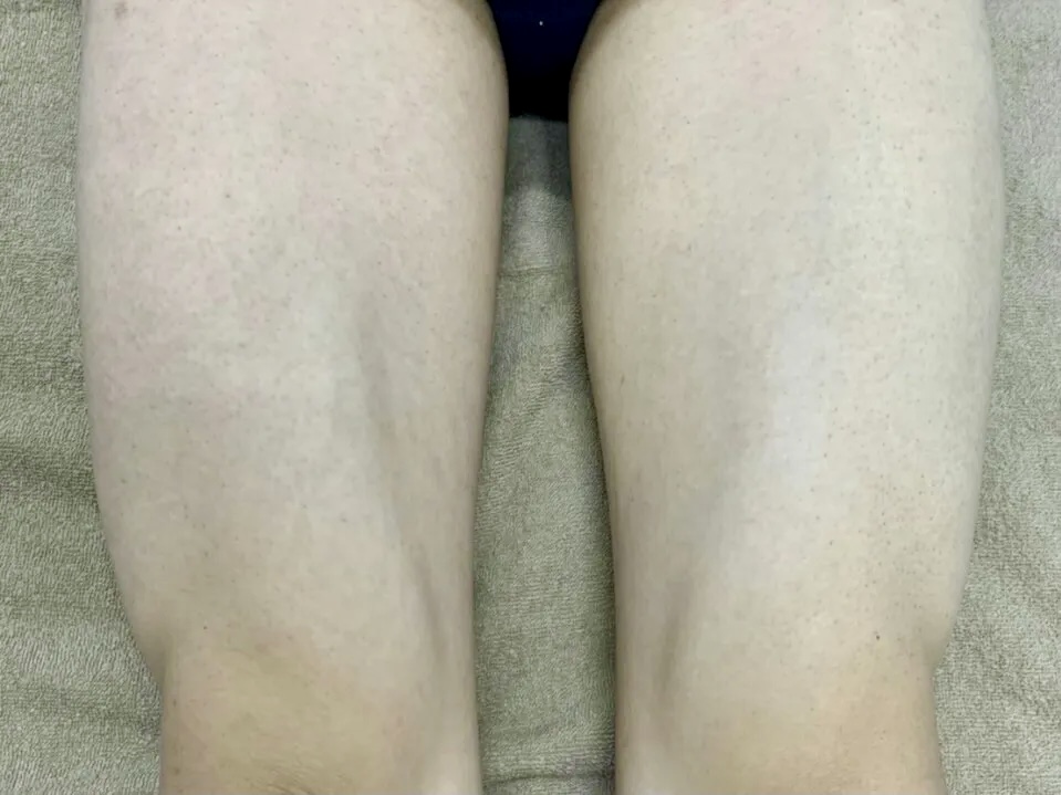 20代男性 足脱毛 施術後