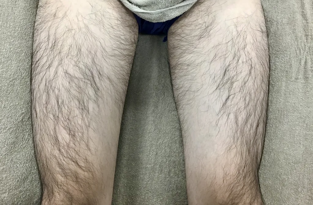 20代男性 足脱毛 施術前
