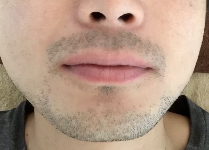 ヒゲ脱毛 Before