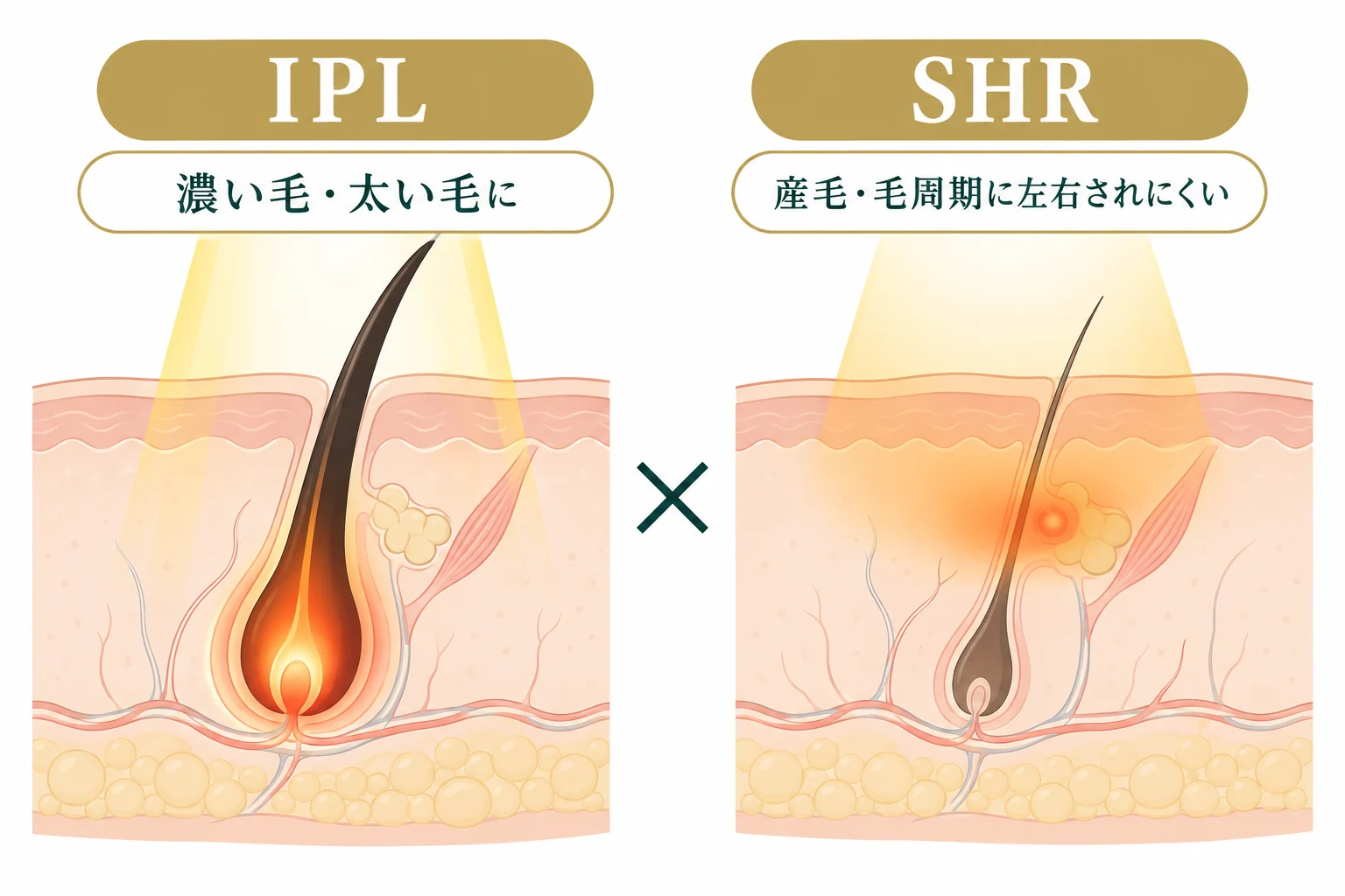IPLとSHRの違い｜IPLは濃い毛・太い毛に、SHRは産毛にも対応し毛周期に左右されにくい｜KNIGHT武蔵新城店