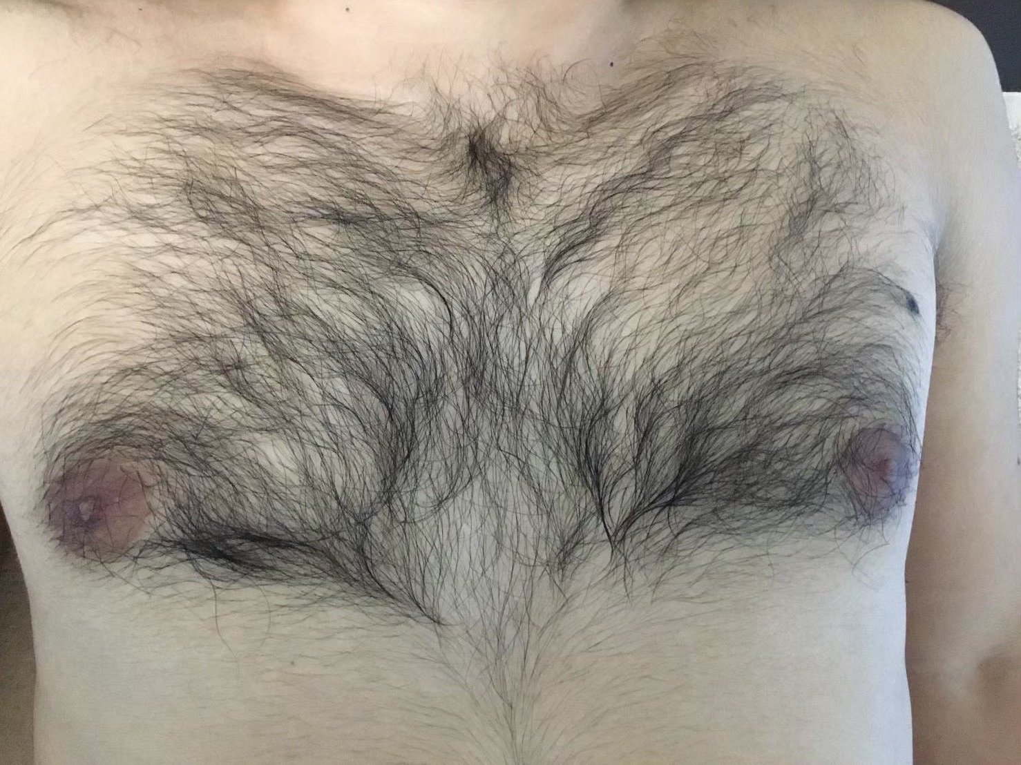 40代男性 胸脱毛 施術前