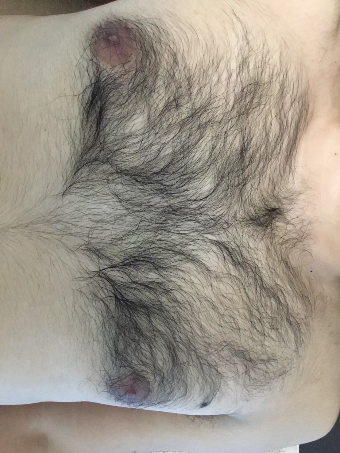 胸脱毛 Before