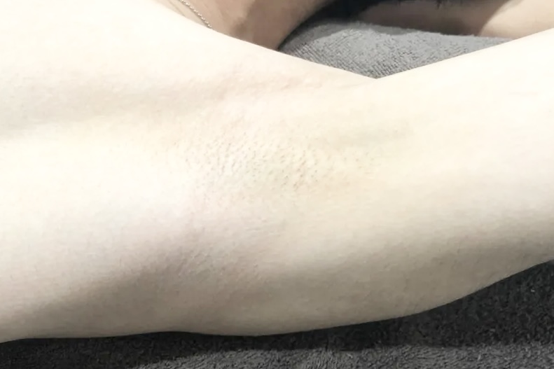 脇脱毛 After