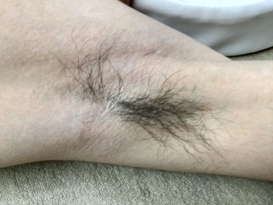 脇脱毛 Before