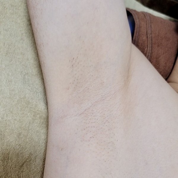 30代男性 脇脱毛 施術後