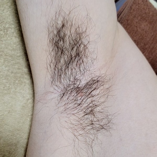 30代男性 脇脱毛 施術前